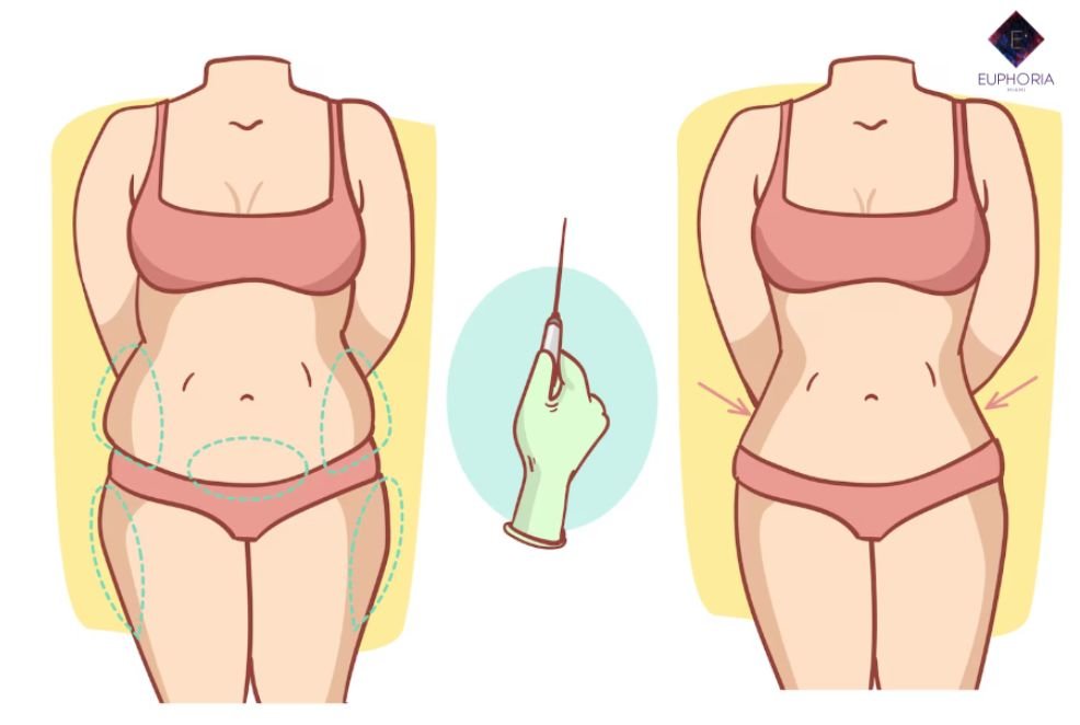 Non-Surgical Body Contouring Before and After